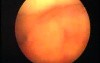 Hysteroscopic Aspect Of Adenomyosis