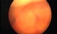 Hysteroscopic Aspect Of Adenomyosis