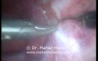 Thorascopic Sympathectomy