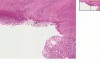 Chronic peptic ulcer, penetrating - Histopathology - Small intestine, duodenum