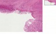 Chronic peptic ulcer, penetrating - Histopathology - Small intestine, duodenum
