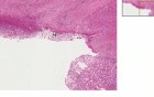 Chronic peptic ulcer, penetrating - Histopathology - Small intestine, duodenum