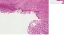 Chronic peptic ulcer, penetrating - Histopathology - Small intestine, duodenum