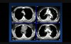 Robotic Resection of Thymoma and Neuroendocrine Tumors