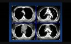 Robotic Resection of Thymoma and Neuroendocrine Tumors