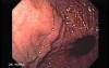 Esophageal Varices and Hiatus Hernia - the Closer Look at Hernia