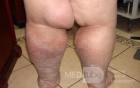 Elephantiasis nostras verrucosa on the legs with morbid
 obesity (1 of 5)
