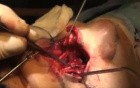 Superior Rhinotomy - Olfactory Neuroblastoma