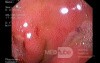Duodenal Ulcer