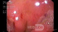 Duodenal Ulcer