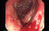 Lymphoma B small cells of the Jejuno (5 of 10)