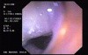 Adenocarcinoma of the Transverse Colon (1 of 2)