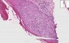 Actinic keratosis - Histopathology of skin