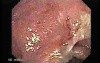Ulcerative Colitis Complicating Colon Cancer (2 of 4)