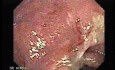 Ulcerative Colitis Complicating Colon Cancer (2 of 4)