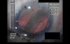 Cataract Surgery V - Part 1