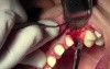Flap Design & Pilot Hole - Implant Surgery, #11 Site