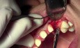 Flap Design & Pilot Hole - Implant Surgery, #11 Site