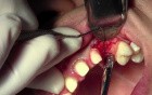 Flap Design & Pilot Hole - Implant Surgery, #11 Site