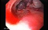 Esophageal Varix -  Endoscopic Image of Ligation of Esophageal Varices