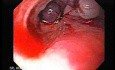 Esophageal Varix -  Endoscopic Image of Ligation of Esophageal Varices