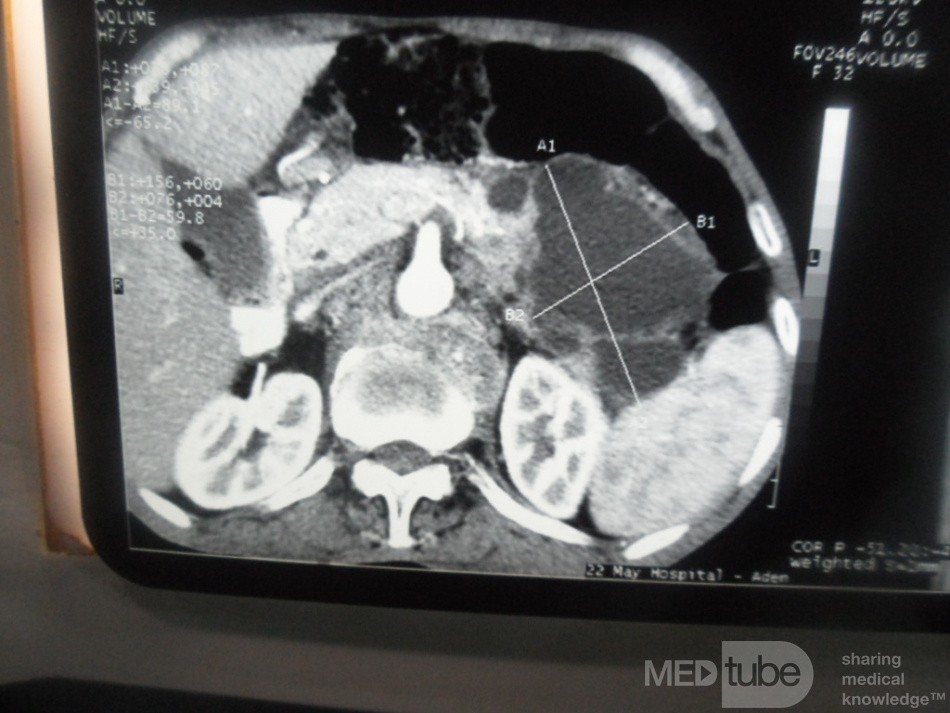 Pancreas cancer - 11