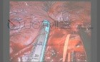 Uniportal VATS Middle Lobectomy Lung Cancer