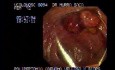 Video Colonoscopic view of a polypectomy of a big 6 cm. x 4 cm. sessile lesion (1 of 4)