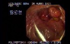 Video Colonoscopic view of a polypectomy of a big 6 cm. x 4 cm. sessile lesion (1 of 4)