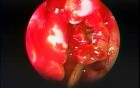 Lacrimal Bone Dehiscence - Endoscopy