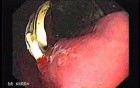 Penetration of Adjustable Laparoscopic Gastric Banding (2 of 4)