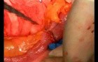 Open Right Hemicolectomy – Technical Principles - Operation No 2 - Part 5