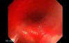 Giant Tubulo - Villous Adenoma (10 of 17)