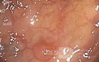 Tubular Adenoma