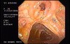 Adenocarcinoma Of The Transverse Colon - Endoscopy (8 of 9)