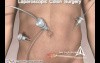 Colorectal cancer surgery - 3D Medical Animation