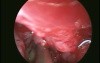 Maxillary Sinus Pyocele
