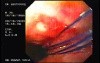 Flexible Endoscopic Suturing - Converting Four Threads into Two