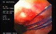 Flexible Endoscopic Suturing - Converting Four Threads into Two