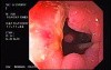 Diverticulitis Of The Sigmoid (2 of 2)