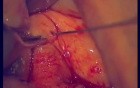 Regeneration Of Multialveolar Process (Left-Side) (2/3)