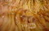 Toxic Dilatation of the Colon Superimposed pseudomembranous colitis involving the
 right colon (14 of 17)