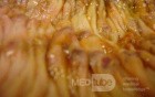 Toxic Dilatation of the Colon Superimposed pseudomembranous colitis involving the
 right colon (14 of 17)