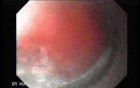 Dieulafoy´s Lesion (Exulceratio Simplex) (4 of 9)