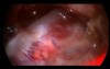 Petroclival Endoscopic Inspection
