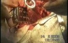 Lobectomy - Lung Cancer Surgery
