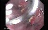 Esophageal Squamous Cell Carcinoma - Visualization of the Lesion