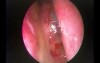 Posterior Nasal Septal Cholesterol Cyst - Endoscopic Removal