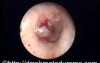 Haemorrhagic Bullous Myringitis