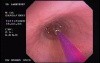 Zollinger- Ellison Syndrome - Gastric Ulcer with Gastrocolic Fistula (15 of 21)